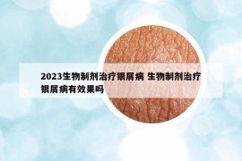 2023生物制劑治療銀屑病 生物制劑治療銀屑病有效果嗎