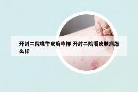 開封二院瞧牛皮癬咋樣 開封二院看皮膚病怎么樣