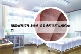 銀屑病可樂可以喝嗎 銀屑病可樂可以喝嗎女性