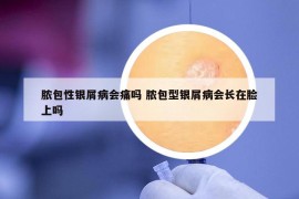 膿包性銀屑病會(huì)痛嗎 膿包型銀屑病會(huì)長(zhǎng)在臉上嗎