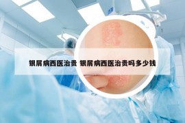 銀屑病西醫(yī)治貴 銀屑病西醫(yī)治貴嗎多少錢