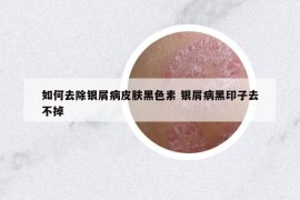 如何去除銀屑病皮膚黑色素 銀屑病黑印子去不掉