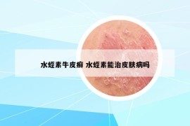 水蛭素牛皮癬 水蛭素能治皮膚病嗎