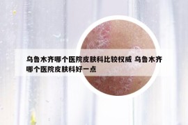 烏魯木齊哪個(gè)醫(yī)院皮膚科比較權(quán)威 烏魯木齊哪個(gè)醫(yī)院皮膚科好一點(diǎn)