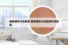 銀屑病可以吃蒜苗 銀屑病可以吃蒜苗炒雞蛋嗎