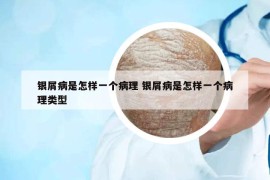 銀屑病是怎樣一個(gè)病理 銀屑病是怎樣一個(gè)病理類型