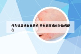 丹東銀屑病有補(bǔ)助嗎 丹東銀屑病有補(bǔ)助嗎現(xiàn)在