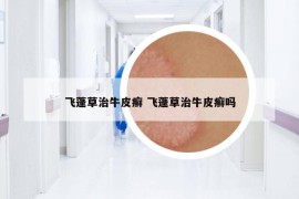 飛蓬草治牛皮癬 飛蓬草治牛皮癬嗎