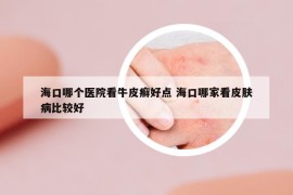 ?？谀膫€醫(yī)院看牛皮癬好點 ?？谀募铱雌つw病比較好
