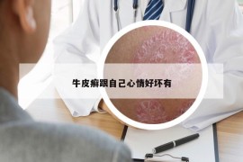 牛皮癬跟自己心情好壞有
