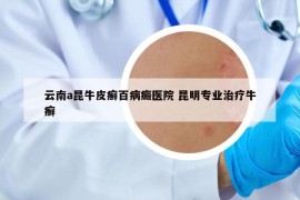 云南a昆牛皮癬百病癜醫(yī)院 昆明專業(yè)治療牛癬
