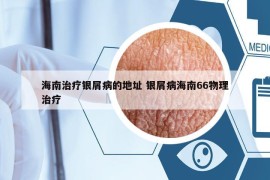 海南治療銀屑病的地址 銀屑病海南66物理治療