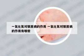 一氧化氮對銀屑病的作用 一氧化氮對銀屑病的作用有哪些