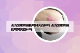 點(diǎn)滴型銀屑病能喝阿莫西林嗎 點(diǎn)滴型銀屑病能喝阿莫西林嗎
