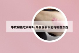 牛皮癬能吃海帶嗎 牛皮皮癬不能吃哪些東西
