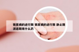銀屑病的進行期 銀屑病的進行期 靜止期 消退期用什么藥