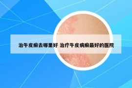 治牛皮癬去哪里好 治療牛皮病癬最好的醫(yī)院
