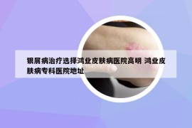 銀屑病治療選擇鴻業(yè)皮膚病醫(yī)院高明 鴻業(yè)皮膚病專科醫(yī)院地址