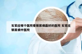 石家莊哪個醫(yī)院看銀屑病最好的醫(yī)院 石家莊銀屑病中醫(yī)院