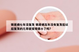 銀屑病七年沒復(fù)發(fā) 銀屑病五年沒有復(fù)發(fā)后以后復(fù)發(fā)的幾率就變得很小了嗎?