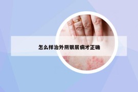 怎么樣治外陰銀屑病才正確