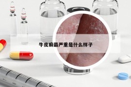 牛皮癬最嚴(yán)重是什么樣子