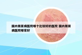 國內(nèi)銀屑病醫(yī)院哪個比較好的醫(yī)院 國內(nèi)銀屑病醫(yī)院哪家好
