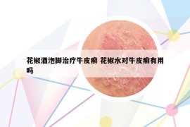 花椒酒泡腳治療牛皮癬 花椒水對牛皮癬有用嗎