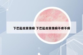 下巴起皮屑像癬 下巴起皮屑像癬不疼不癢