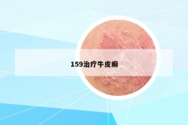 159治療牛皮癬