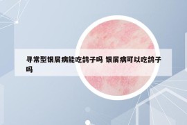尋常型銀屑病能吃鴿子嗎 銀屑病可以吃鴿子嗎