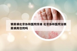 銀屑病北京協(xié)和醫(yī)院找誰 北京協(xié)和醫(yī)院治銀屑病用住院嗎