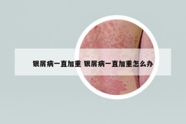 銀屑病一直加重 銀屑病一直加重怎么辦
