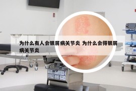 為什么有人會(huì)銀屑病關(guān)節(jié)炎 為什么會(huì)得銀屑病關(guān)節(jié)炎
