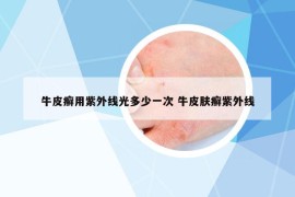 牛皮癬用紫外線(xiàn)光多少一次 牛皮膚癬紫外線(xiàn)