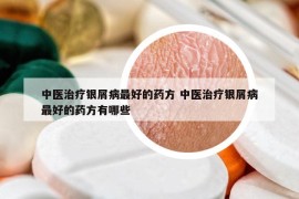 中醫(yī)治療銀屑病最好的藥方 中醫(yī)治療銀屑病最好的藥方有哪些
