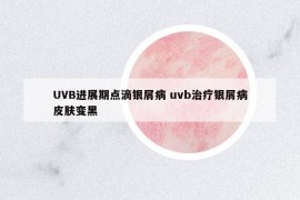 UVB進(jìn)展期點(diǎn)滴銀屑病 uvb治療銀屑病皮膚變黑