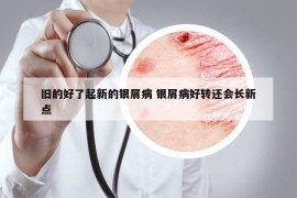 舊的好了起新的銀屑病 銀屑病好轉(zhuǎn)還會(huì)長(zhǎng)新點(diǎn)