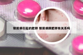 銀屑病引起的肥胖 銀屑病跟肥胖有關(guān)系嗎
