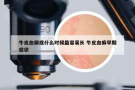 牛皮血癬癥什么時候最容易長 牛皮血癬早期癥狀