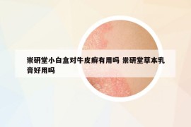 崇研堂小白盒對(duì)牛皮癬有用嗎 祟研堂草本乳膏好用嗎
