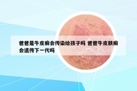 爸爸是牛皮癬會傳染給孩子嗎 爸爸牛皮膚癬會遺傳下一代嗎