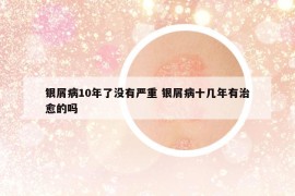 銀屑病10年了沒有嚴重 銀屑病十幾年有治愈的嗎