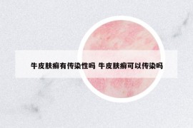 牛皮膚癬有傳染性嗎 牛皮膚癬可以傳染嗎