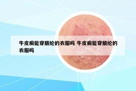 牛皮癬能穿腈綸的衣服嗎 牛皮癬能穿腈綸的衣服嗎