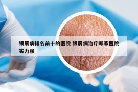 銀屑病排名前十的醫(yī)院 銀屑病治療哪家醫(yī)院實力強