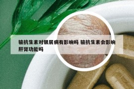 輸抗生素對銀屑病有影響嗎 輸抗生素會影響肝腎功能嗎