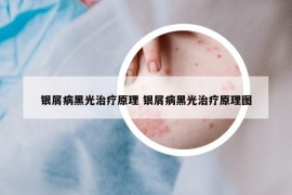 銀屑病黑光治療原理 銀屑病黑光治療原理圖