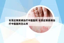 石家莊銀屑病治療中醫(yī)醫(yī)院 石家莊銀屑病治療中醫(yī)醫(yī)院怎么樣