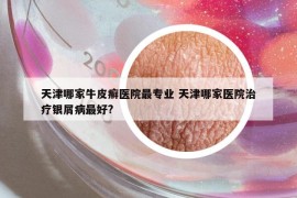 天津哪家牛皮癬醫(yī)院最專業(yè) 天津哪家醫(yī)院治療銀屑病最好?